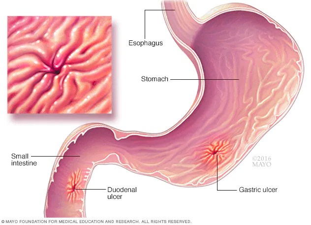 Stomach Ulcers: Causes and Remedies